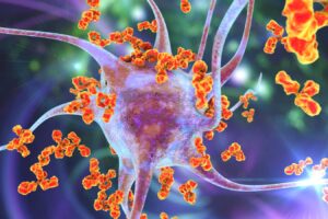 Possible Origin Of Multiple Sclerosis Gene: Protection Against Infection In