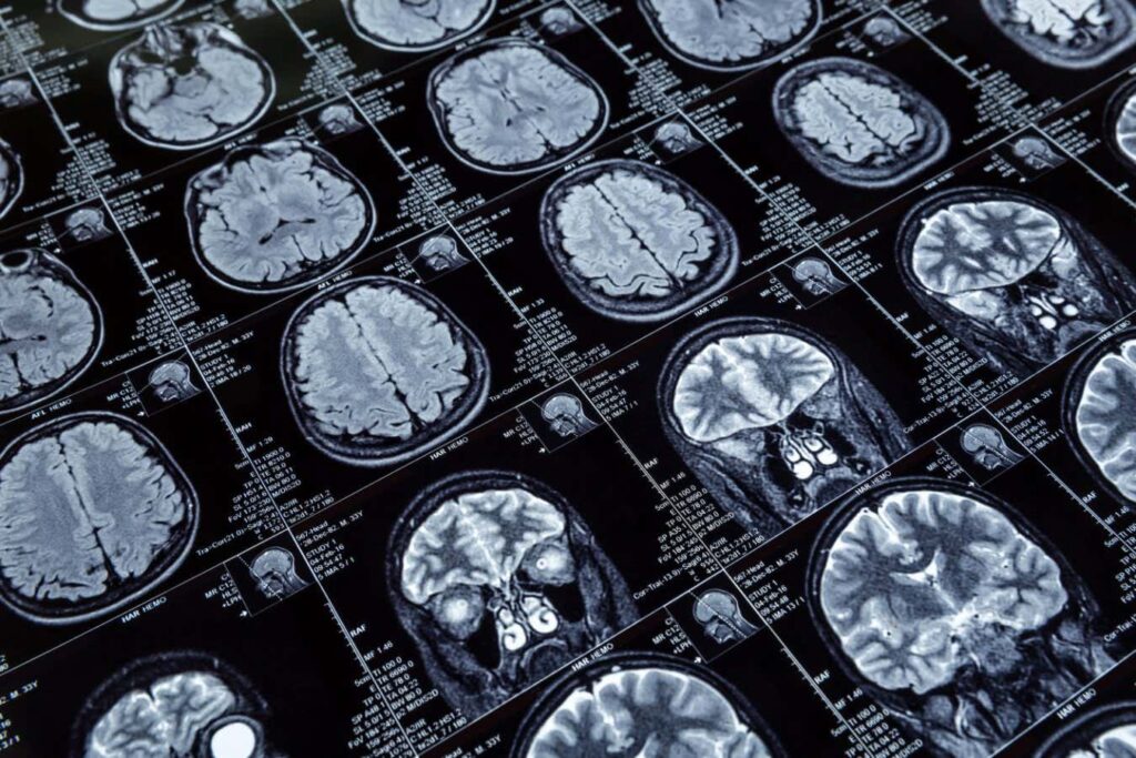 Ai Can Accurately Determine A Person's Gender From A Brain