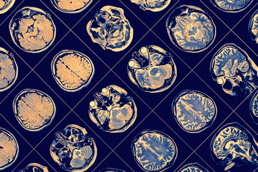 Recognizing Gender Disparities In The Brain Is Crucial For Mental