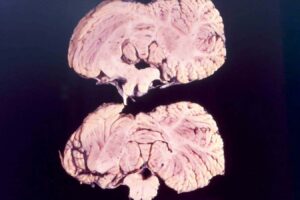 Kuhl: Genetic Mutations Could Provide Protection Against Brain Diseases Linked