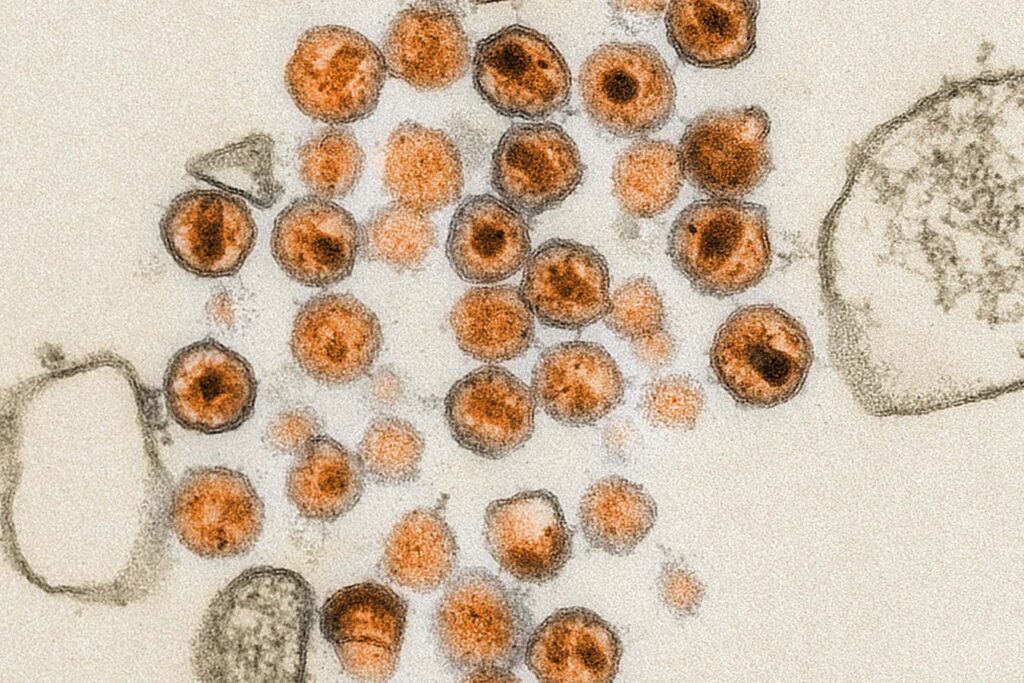 Lab Experiment Suggests Crispr Can Disable And Treat Hiv