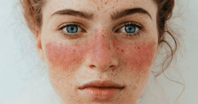 Researchers Have Pinpointed The Underlying Cause Of Lupus, Scientists Report
