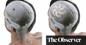 Brain Implants For Treatment Of Epilepsy, Arthritis, And Incontinence: A