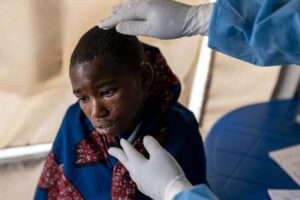 Mpox: Understanding The Fatality Rate And Treatment Options Of The