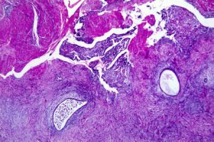 Simplified Diagnosis Of Endometriosis Possible With Stool Test