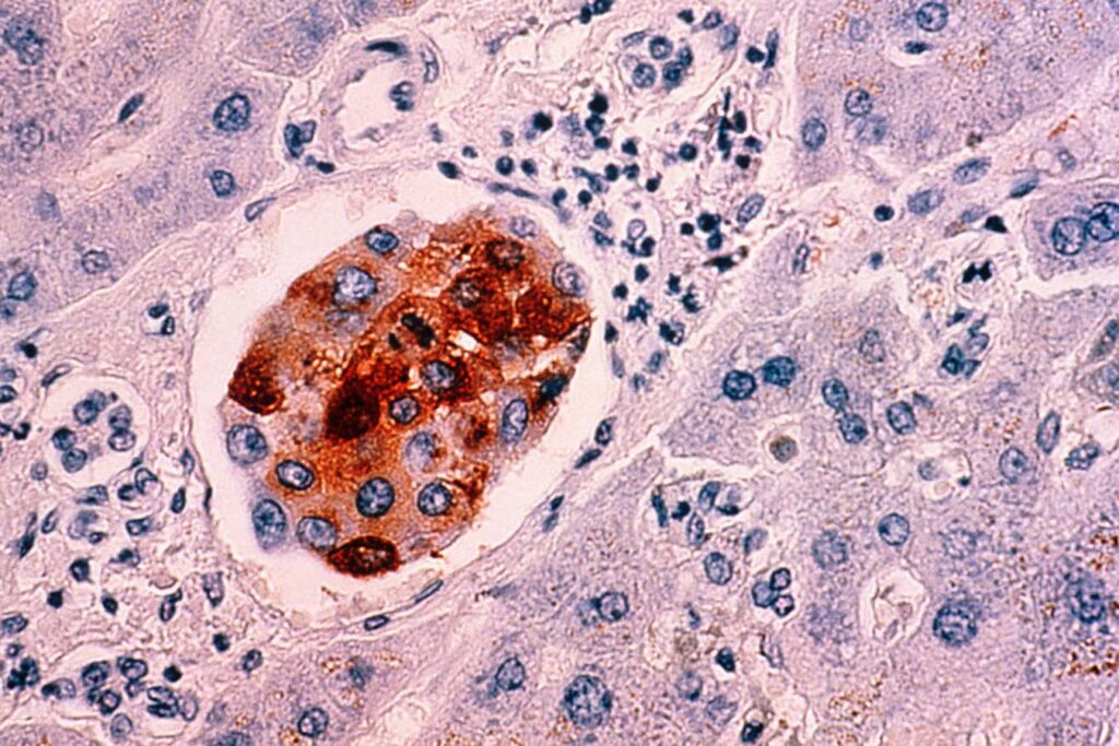 Global Cancer Related Deaths Projected To Nearly Double By 2050