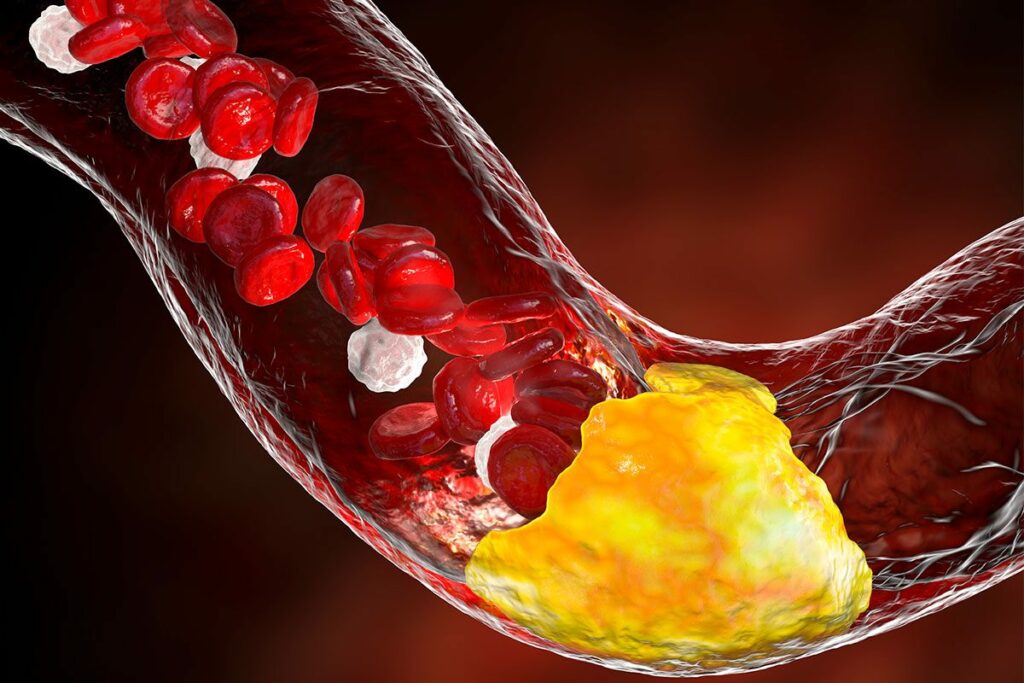 The impact of cholesterol levels on the risk of developing dementia The Impact Of Cholesterol Levels On The Risk Of Developing