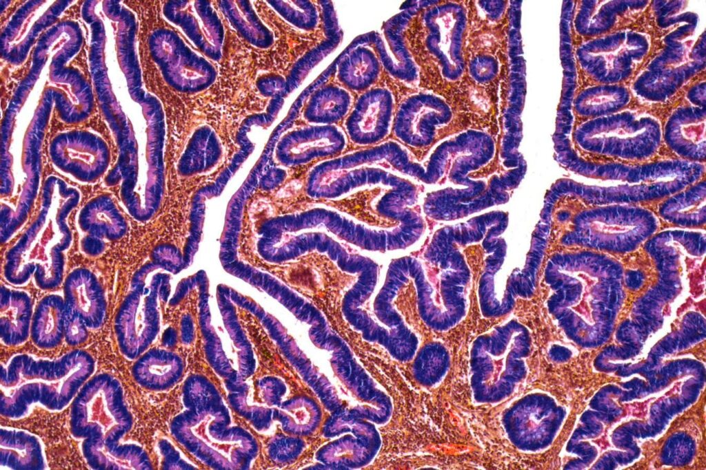 The incidence of colorectal cancer is increasing in young populations globally The Incidence Of Colorectal Cancer Is Increasing In Young Populations