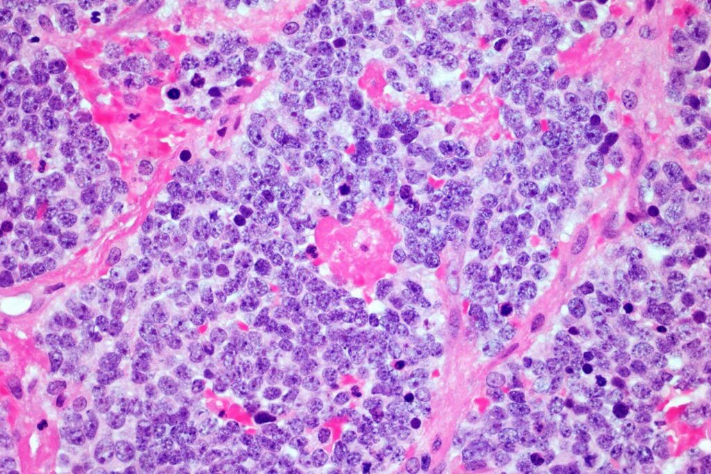 Car T Cells Achieve An Unprecedented 18 Year Remission In Neurocarcinoma