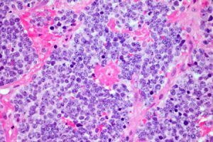 Car T Cells Achieve An Unprecedented 18 Year Remission In Neurocarcinoma