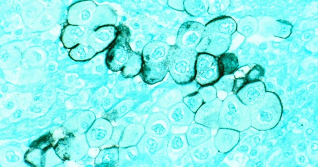 Early Trials Suggest Mrna Vaccines Hold Potential For Treating Pancreatic