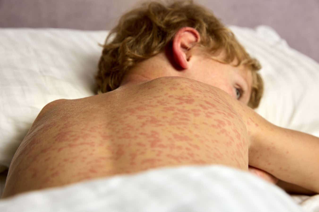 What you need to know about the spreading measles outbreak