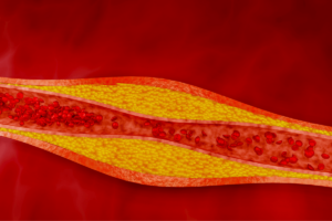 New research on cholesterol levels and dementia risk