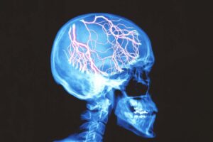 Migraine medications that alleviate headaches and dizziness symptoms