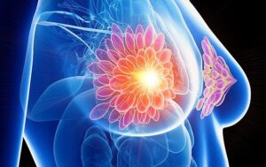 Researchers Utilize Enhanced DNA Techniques to Classify Breast Cancer