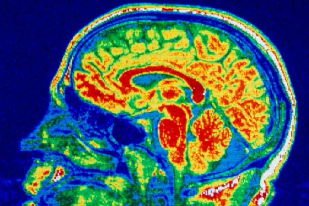 Brain Changes from Eating Disorders Mirror Those Seen in OCD