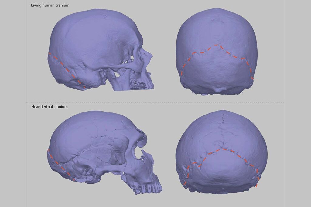 Neanderthal-Shaped Skulls Could Shed Light on Why Some Individuals Experience Headaches Neanderthal Shaped Skulls Could Shed Light on Why Some Individuals Experience