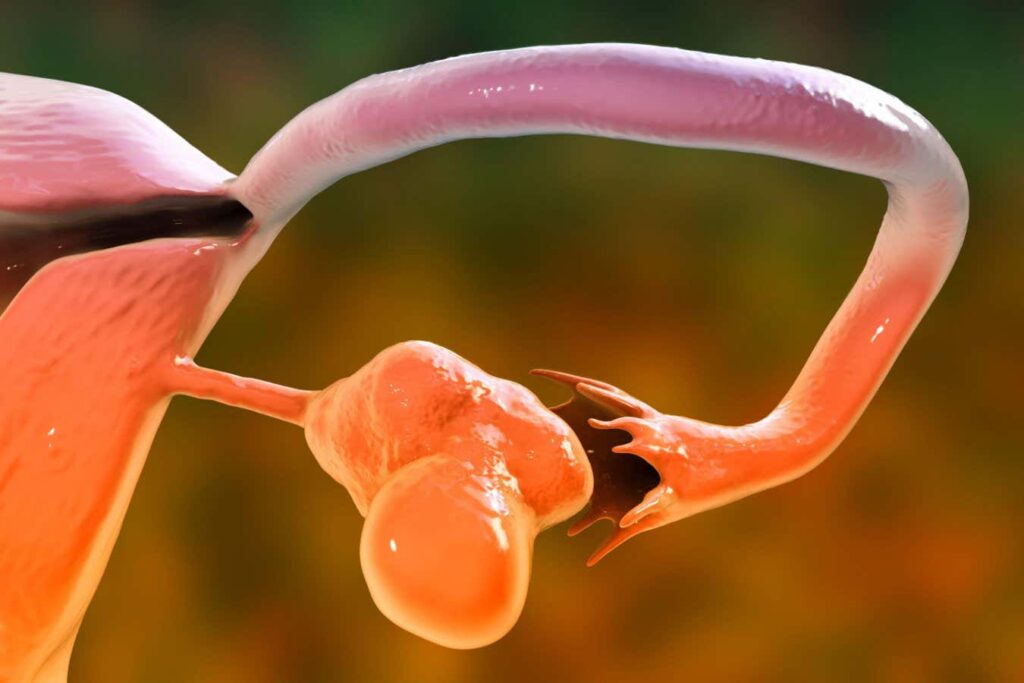 Polycystic Ovary Syndrome May Be Inherited Through Chemical Modifications of DNA Polycystic Ovary Syndrome May Be Inherited Through Chemical Modifications of