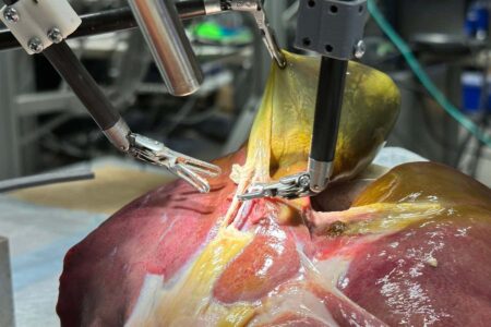 Surgical Robots Advance Closer to Complete Autonomy in Operations Surgical Robots Advance Closer to Complete Autonomy in Operations