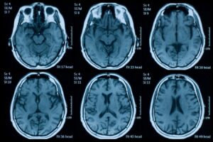 The pandemic might have accelerated brain aging even before we