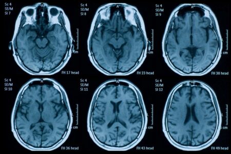 The pandemic might have accelerated brain aging even before we