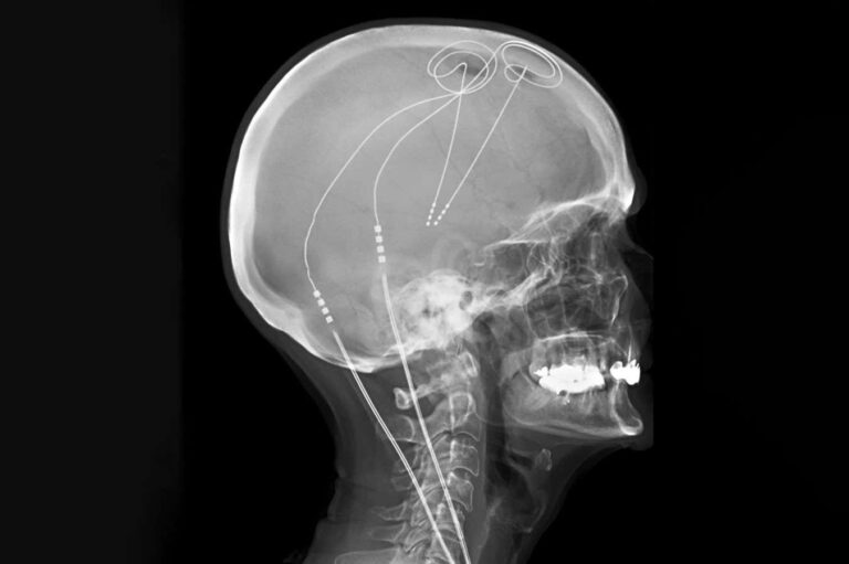 Tailored Brain Implants Offer Lasting Relief from Chronic Pain Tailored Brain Implants Offer Lasting Relief from Chronic Pain