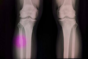 Hot Glue Gun A Surprising Solution for Repairing Broken Bones