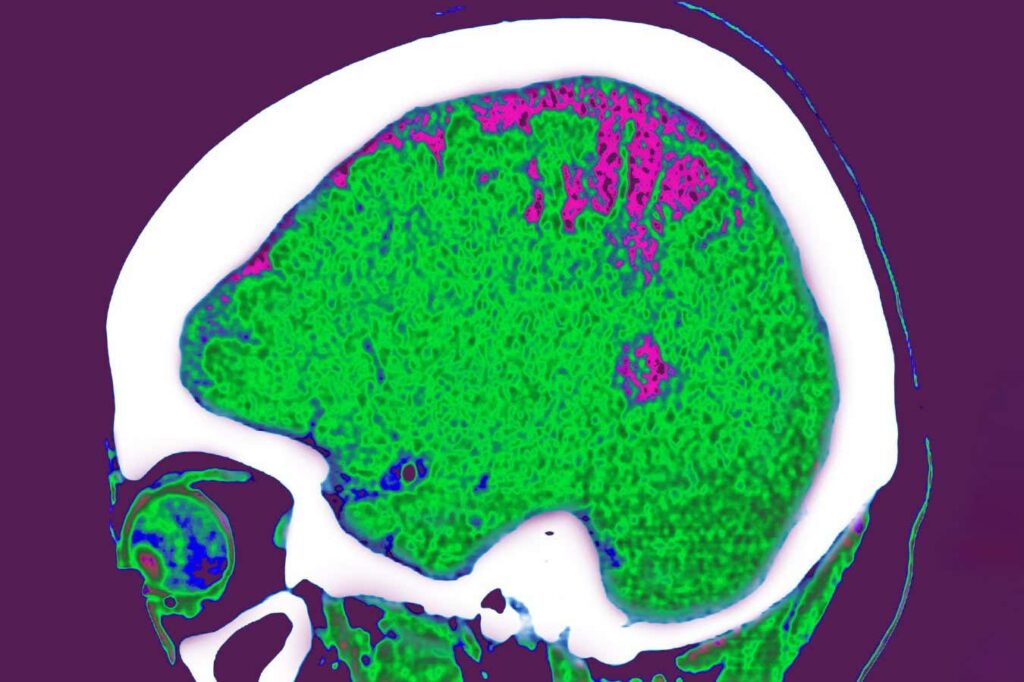 How Fat Storage Locations Impact Brain Function
