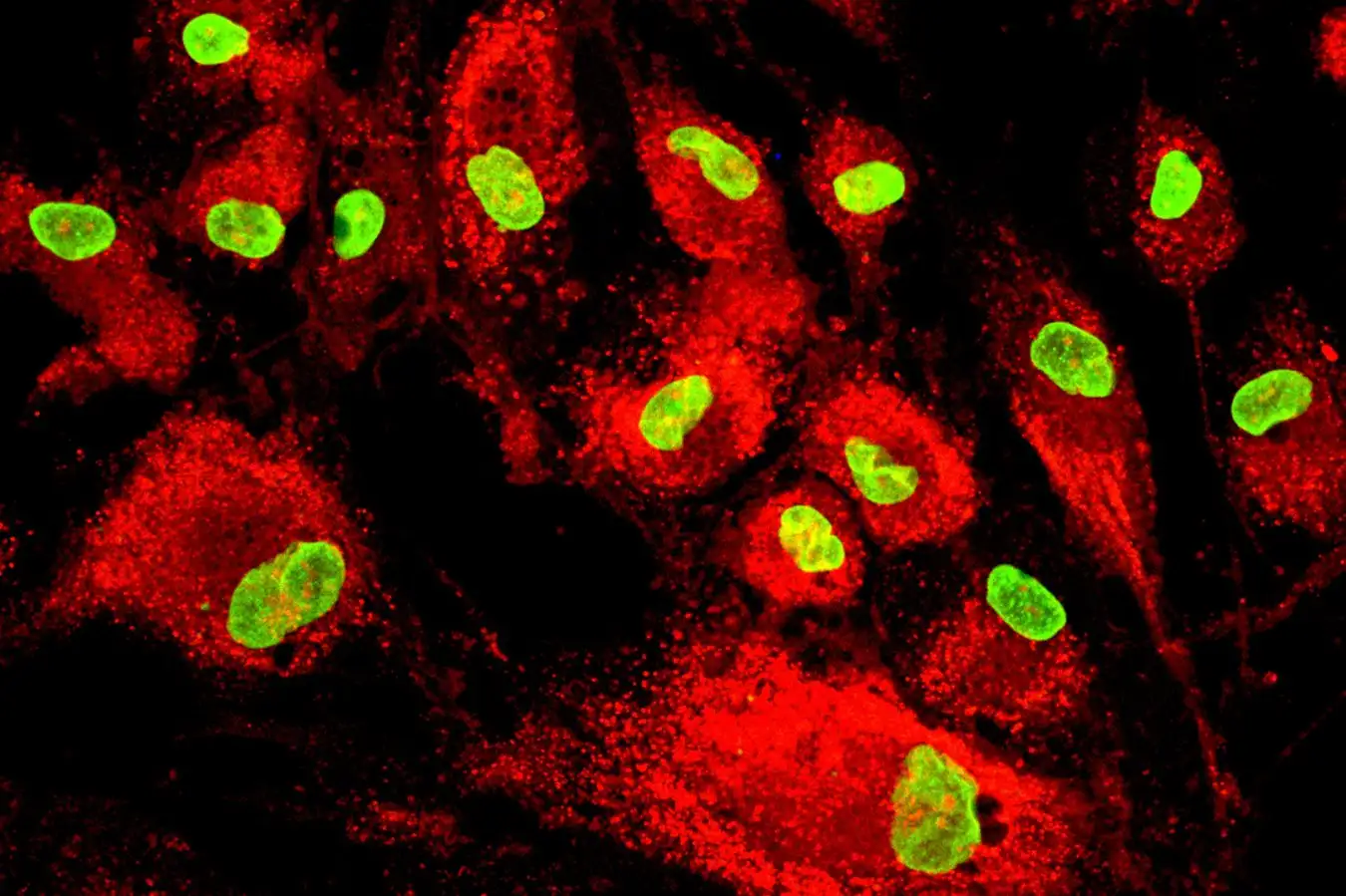 Stem Cell Therapy Lowers Heart Failure Risk Following Heart Attack Stem Cell Therapy Lowers Heart Failure Risk Following Heart Attack