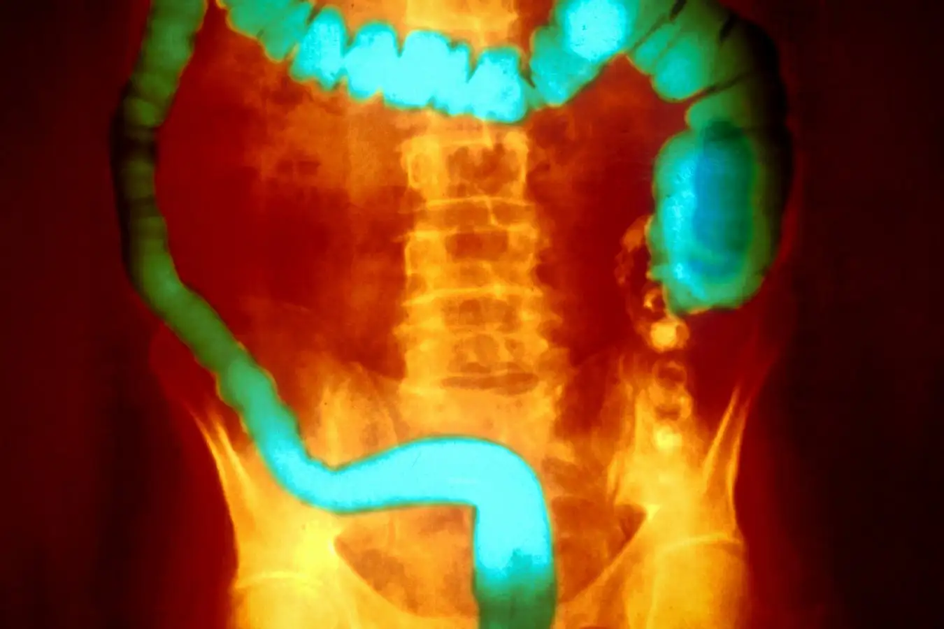 Common Types of Inflammatory Bowel Disease Linked to Harmful Bacteria