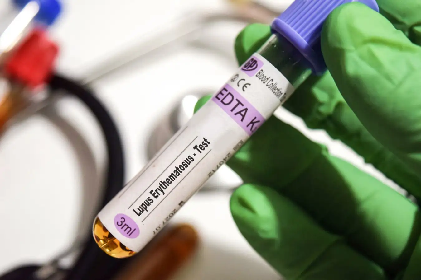 Compelling Evidence Links Epstein Barr Virus to Lupus Development