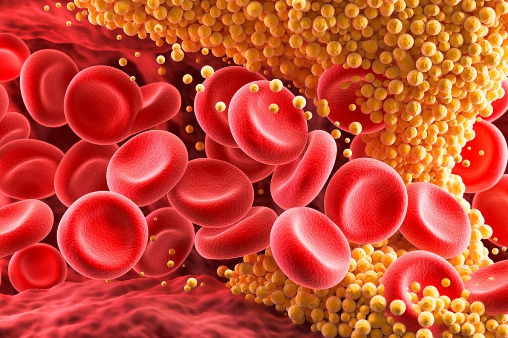 Revolutionary Single Treatment May Permanently Eliminate High Cholesterol