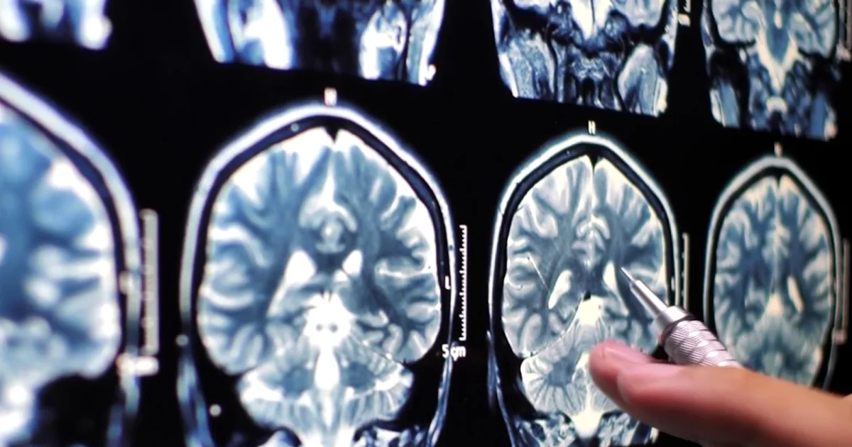 How Time in Space Affects Astronauts Brain Health Exploring the