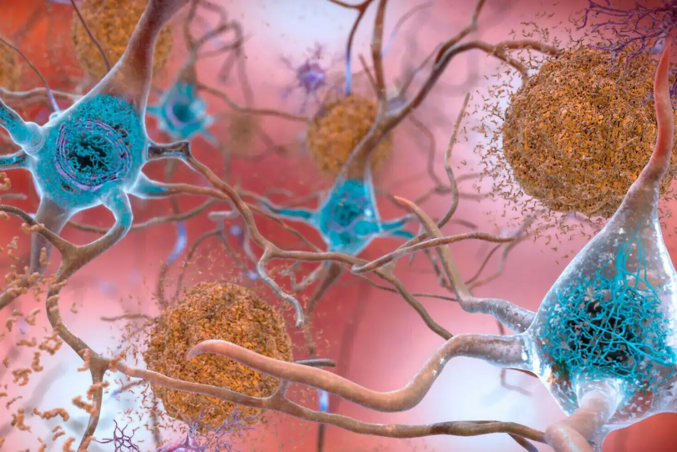 Understanding Why Alzheimers Disease Related Brain Damage Doesnt Immediately Trigger Symptoms