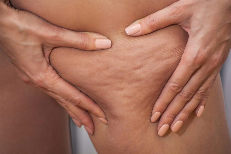 Discover the Real Cause of Cellulite and Effective Reduction Tips Discover the Real Cause of Cellulite and Effective Reduction Tips