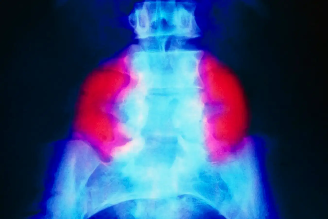 Stem Cell Patch Successfully Repairs Brain Damage in Spina Bifida