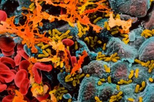 How Cystitis and Tooth Decay Can Contribute to Dementia in Later Years How Cystitis and Tooth Decay Can Contribute to Dementia in