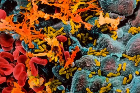 How Cystitis and Tooth Decay Can Contribute to Dementia in Later Years How Cystitis and Tooth Decay Can Contribute to Dementia in