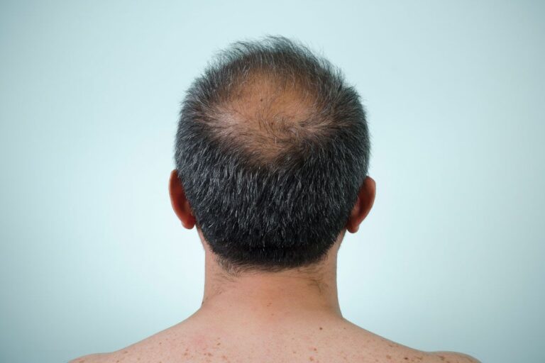 Scientists Discover Potential Cure for Baldness: Here’s How It Works Scientists Discover Potential Cure for Baldness Heres How It Works