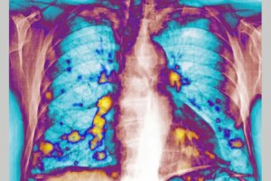 Does Catching a Cold Slow Lung Cancer Metastasis