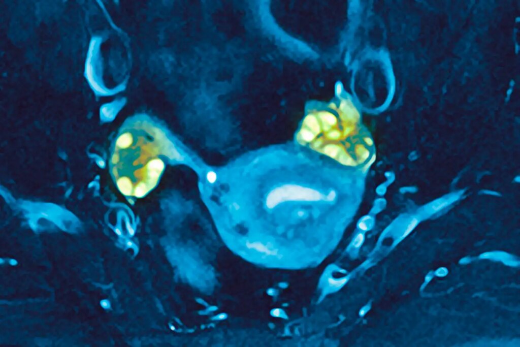 How PCOS Can Delay Perimenopause and Enable Later Age Pregnancy