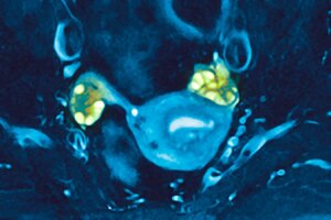 How PCOS Can Delay Perimenopause and Enable Later Age Pregnancy