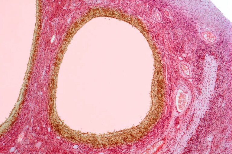 PCOS Rebranded as PMOS A Major Update in Womens Health