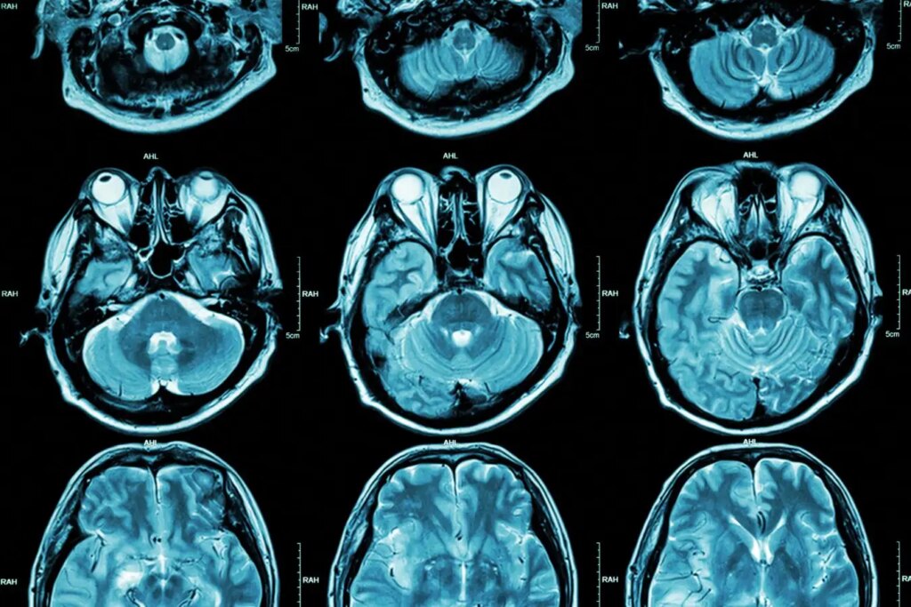 Exploring Two Distinct Autism Subtypes Linked to Varying Brain Activity Exploring Two Distinct Autism Subtypes Linked to Varying Brain Activity