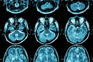 Exploring Two Distinct Autism Subtypes Linked to Varying Brain Activity Exploring Two Distinct Autism Subtypes Linked to Varying Brain Activity