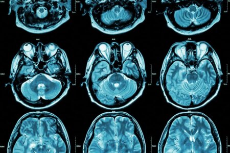Exploring Two Distinct Autism Subtypes Linked to Varying Brain Activity