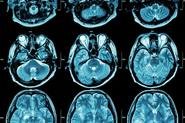 Exploring Two Distinct Autism Subtypes Linked to Varying Brain Activity