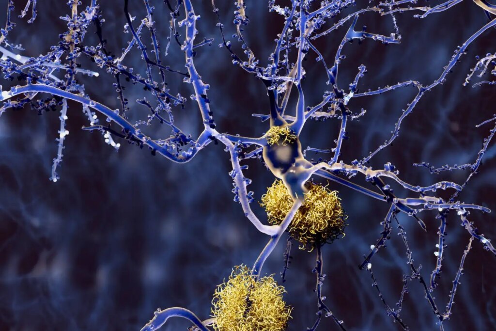 Groundbreaking Large-Scale Study Uncovers New Drug Targets in Alzheimer’s Disease Genetics Groundbreaking Large Scale Study Uncovers New Drug Targets in Alzheimers Disease