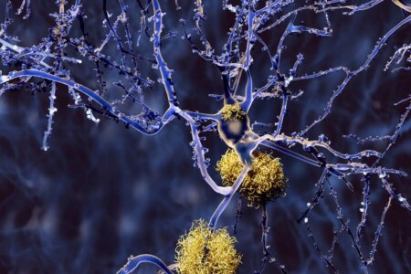 Groundbreaking Large-Scale Study Uncovers New Drug Targets in Alzheimer’s Disease Genetics Groundbreaking Large Scale Study Uncovers New Drug Targets in Alzheimers Disease