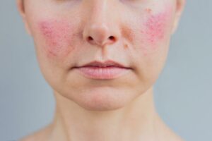 Health Conditions Indicated by a Red Face After Drinking Wine Health Conditions Indicated by a Red Face After Drinking Wine